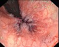 Endoskopische Aufnahme von Hämorrhoiden 1° in analer Blickrichtung (von oral)