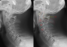 Röntgenfoto van de halswervelkolom met een hangman's fracture, hier ontstaan door een ongeval. Links zonder, rechts met annotatie. Duidelijk is te zien dat C2 (rode markering) naar voren is verschoven t.o.v. C3 (blauwe markering).