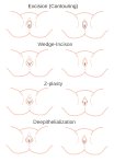 Verschiedene Techniken zur Verkleinerung der inneren Schamlippen
