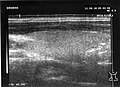 Abb. 2 Ultraschallbild: Rechter Lappen (Längsschnitt)