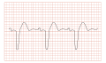 en:Bundle branch block