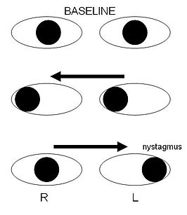 Internucleaire oftalmoplegie