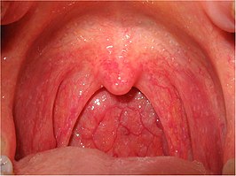 Virale faryngitis. de orofarynx is gezwollen en rood.