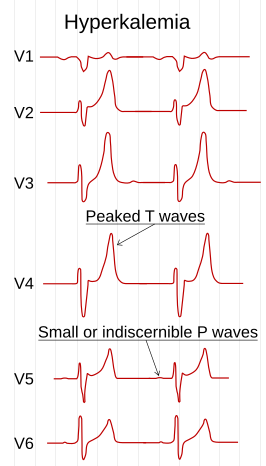 Het ECG-patroon bij hyperkaliëmie.