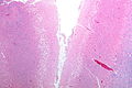 Micrograph showing cortical pseudolaminar necrosis, a finding seen in strokes on medical imaging and at autopsy. H&E-LFB stain.