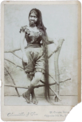 SW-Photo einer jungen Frau mit Hypertrichose