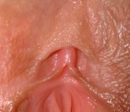 Klitoris ohne Verklebung: Die Vorhaut ist frei verschieblich, die ganze Eichel ist sichtbar. Die sich in beide kleinen Labien aufzweigenden Frenula clitoridis auch gut sichtbar.