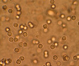 Meerdere witte cellen in de urine van een persoon met een urineweginfectie, gezien via microscopie