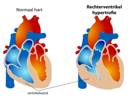 Rechterventrikelhypertofie
