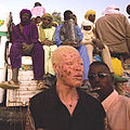 Albino uit Nigeria