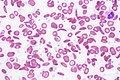 Sickle_Cell_Anemia - by Ed Uthman, Creative Commons Attribution 2.0 Generic license.