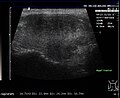 Subakute Thyreoiditis im Ultraschall: diffuse Echoarmut.