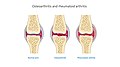 Osteoarthritis and rheumatoid arthritis - Normal joint Osteoarthritis Rheumatoid arthritis