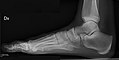 Weight-bearing right foot, lateral