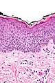 Spongiose: Gefügelockerung der Epidermis mit sichtbaren Spalten zwischen den einzelnen Zellen durch interzelluläres Ödem