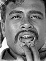 Abgefeilte Zähne bei einem Karo-Mann aus Nord-Sumatra