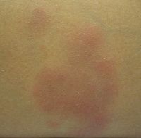 A single lesion of erythema nodosum