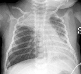 Een thoraxfoto die een hyperinflatie laat zien met een afgevlakt middenrif en bilaterale atelectase in de rechter apicale (longtop) en linker basale (longbasis) regio's bij een 16 dagen oud kind met ernstige bronchiolitis.