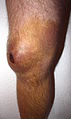 Bursitis am Knie (Bursitis praepatellaris) 10 Tage nach Sturz