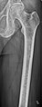 Femur with multiple myeloma lesions.