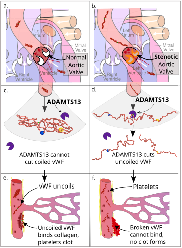 Diagram of the pathophysiology of Heyde's syndrome