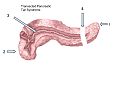 Transected Pancreatic Tail Syndrome.png