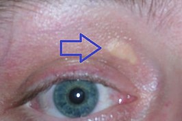 Xanthelasma