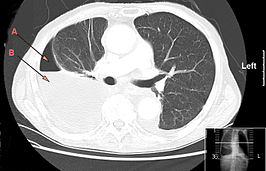 CT-thorax laat een grote rechtszijdige hydro-pneumothorax zien, ontstaan door empyeem. Pijl A: lucht, B: vocht