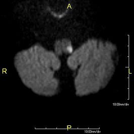 Transversale coupe van een diffusiegewogen MRI-opname van de hersenstam en de kleine hersenen, met een infarct (witte vlek) in de linker dorsale medulla oblongata