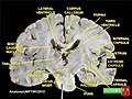 Thalamus coronal section