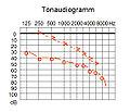 Tonaudiogramm, kombinierte Schwerhörigkeit