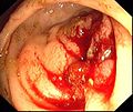 Endoskopische Aufnahme einer durch ein Rektumkarzinom verursachten Stenose