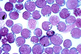 Microscope slide of cells infected with EBV