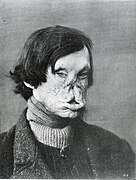 Face severely deformed by leprosy, 1895