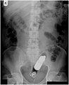 March 2009 – April 2009 X-ray of the abdomen with a vibrator, a sort of sex toy usually used for masturbation in the vagina of a woman, but here seen in the rectum of a man. The absence of a battery means that the vibrator is not operating.