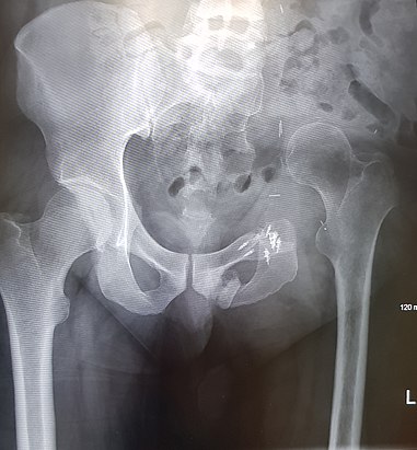 An x-ray of the same pelvis taken eighteen months after surgery highlighting the femur migration to its final resting place.