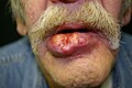 Large squamous-cell carcinoma (SCC) of lower lip