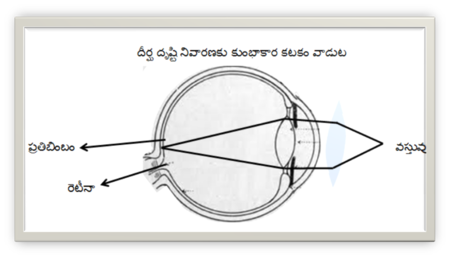 దీర్ఘ దృష్టి దోష నివారణకు కుంభాకార కటకం వాడుట